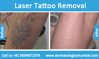 Tattoo Removal in Mumbai, Laser Tattoo Removal | Dermatologist Mumbai