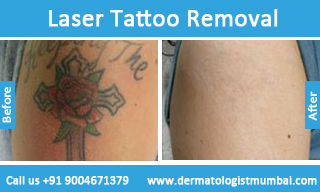 Laser Tattoo Removal Treatment in Mumbai, India - Dr. Rinky Kapoor ...